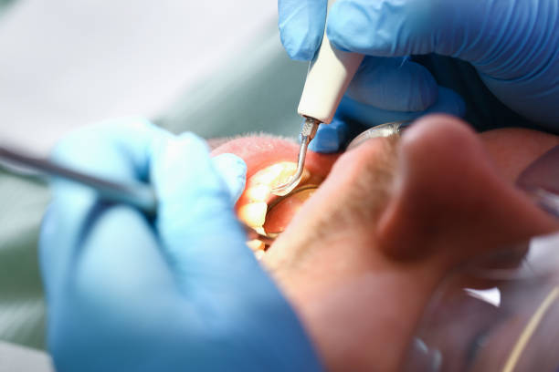 Best Emergency Wisdom Teeth Removal in Ardmore, TN